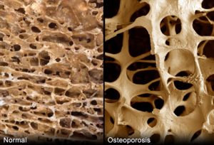 Osteoporosis01