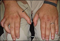 اختلال حرکتی آسیب عصب اولنار دست