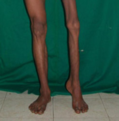 تغییر شکل مچ و کف پا در بیماری فلج اطفال
