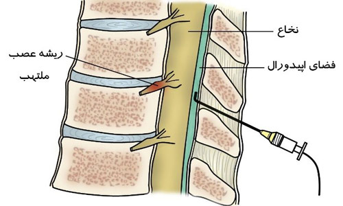 تزریق مفصل بین مهره ای پشتی در ستون فقرات کمری