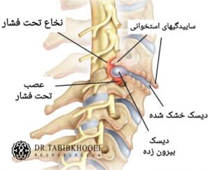 بیماری دیسک گردن: خشک شدن و بیرون زدن دیسک، ساییدگی استخوانی و فشار روی عصبها