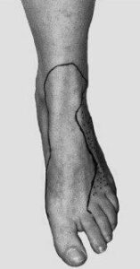 نروپاتی عصب پرونئال سطحی در مچ پا