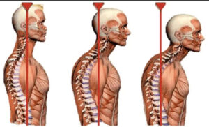 عارضه سر به جلو ، درمان گردن به جلو، ورزشهای سر به جلو، حرکات اصلاحی گردن به جلو