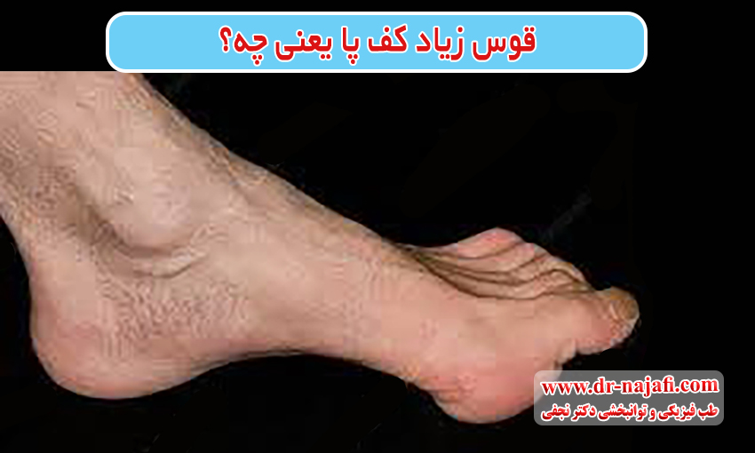 قوس زیاد کف پا یعنی چه؟