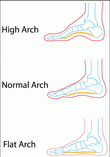 قوس زیاد کف پا ، علل، تشخیص و درمان قوس زیاد کف پا