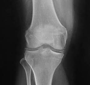 نقرس کاذب چیست