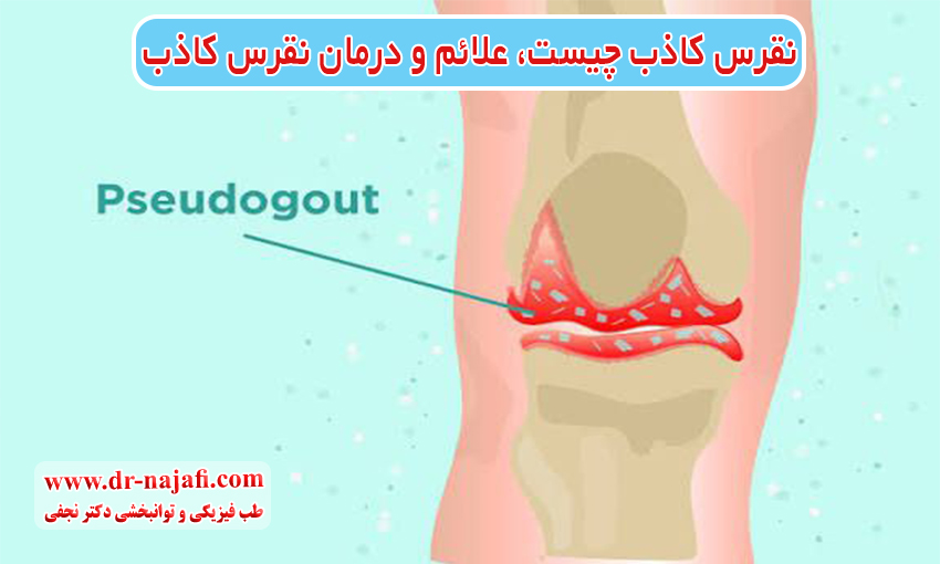 نقرس کاذب چیست، علائم نقرس کاذب، درمان نقرس کاذب
