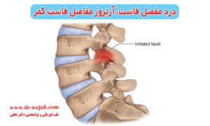 درد مفصل فاست‌، آرتروز مفاصل فاست کمر، درمان کمردرد ناشی از مفصل فاست
