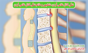 تنگی کانال نخاعی گردن، علامت‌های تنگی کانال نخاعی گردن، تشخیص تنگی کانال نخاعی گردن