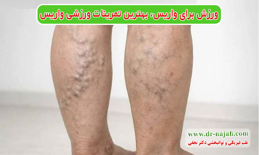ورزش برای واریس، بهترین تمرینات ورزشی واریس